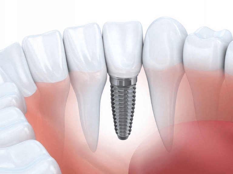 Cấy ghép Implant có nhiều ưu điểm nổi bật