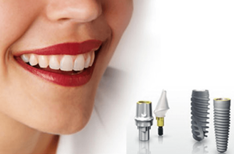 Răng Implant có độ bền lâu dài