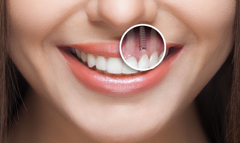 Cấy ghép implant mang đến nhiều ưu điểm vượt trội Cấy ghép implant mang đến nhiều ưu điểm vượt trội
