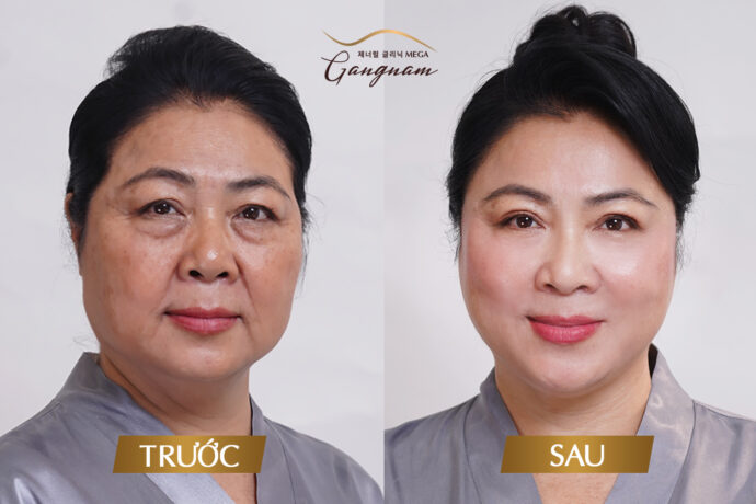 Sau khi thực hiện căng da làn da trở nên căng bóng hơn