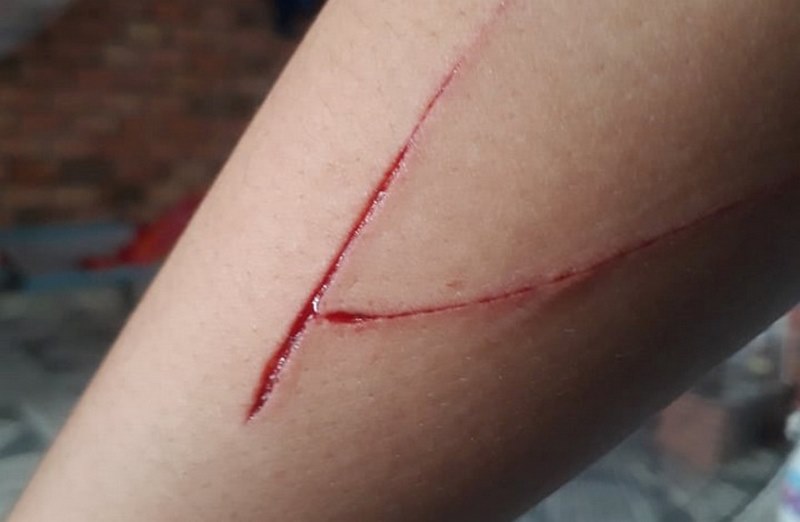 Nằm mơ thấy bị cắt có ý nghĩa gì? Tôi nên đặt cược vào con số nào?