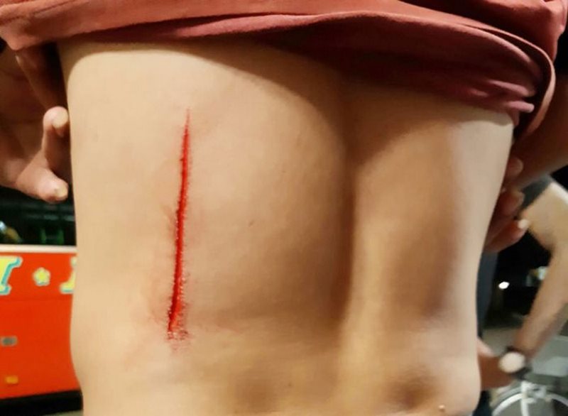 Nằm mơ thấy bị cắt có ý nghĩa gì? Tôi nên đặt cược vào con số nào?