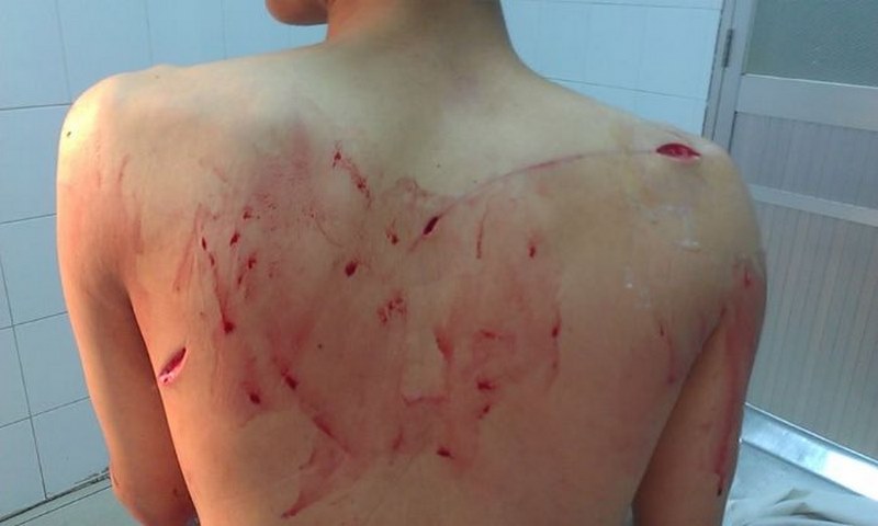 Nằm mơ thấy bị cắt có ý nghĩa gì? Tôi nên đặt cược vào con số nào?